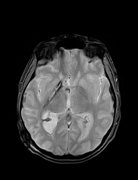 Colloid Cyst Of The 3rd Ventricle Image