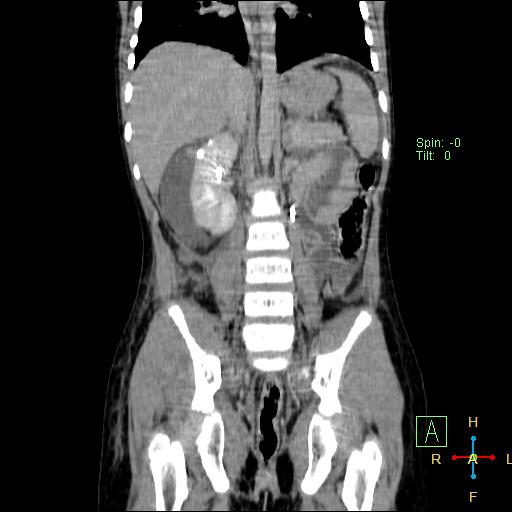 Post traumatic urinoma | Image | Radiopaedia.org