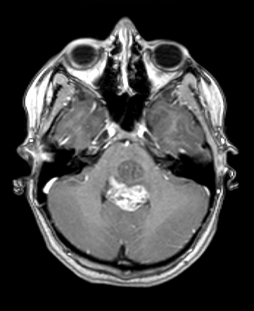 Pilocytic astrocytoma | Radiology Case | Radiopaedia.org