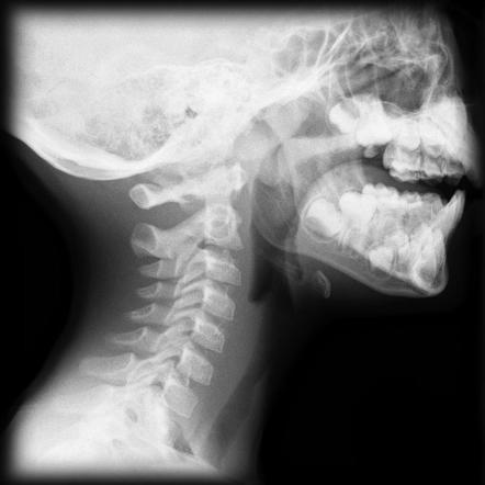 Croup | Radiology Reference Article | Radiopaedia.org