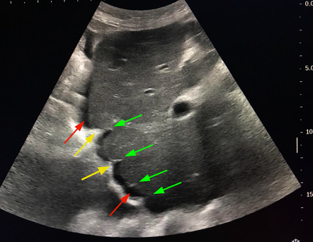 Diaphragmatic Slips Radiology Reference Article Radiopaedia Org