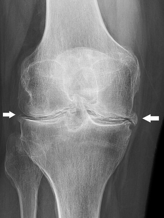 Crystal induced arthropathy (CPPD) | Image | Radiopaedia.org