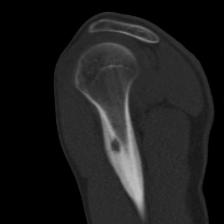 Osteoid osteoma - humerus | Image | Radiopaedia.org