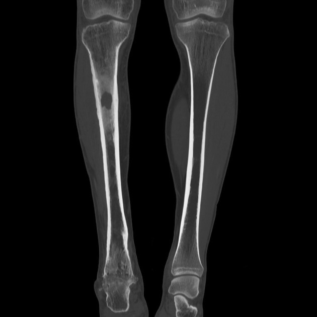 Brodie abscess tibia Radiology Case Radiopaedia