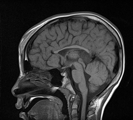 Aicardi syndrome | Radiology Case | Radiopaedia.org