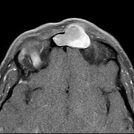 Mucocele Sinus