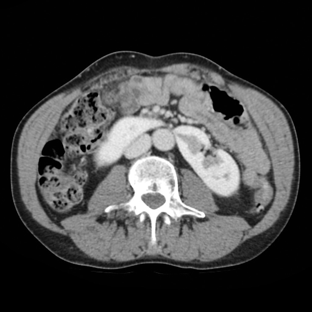 horseshoe-kidney