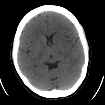 Basal Ganglia CT Scan