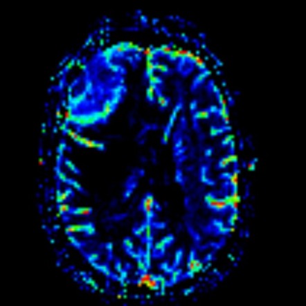 Lymphoma of the skull | Image | Radiopaedia.org