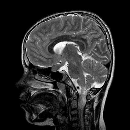 Bilateral optic pathway glioma in neurofibromatosis type1 | Image ...