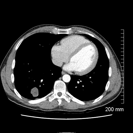 Pulmonary hamartoma | Image | Radiopaedia.org