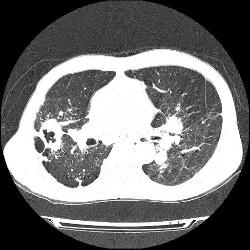 Silicotuberculosis | Image | Radiopaedia.org