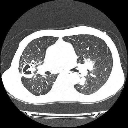 Silicotuberculosis | Radiology Case | Radiopaedia.org