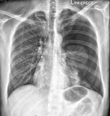 Pneumothorax | Image | Radiopaedia.org