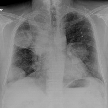 Lung metastases from colorectal cancer | Radiology Case | Radiopaedia.org