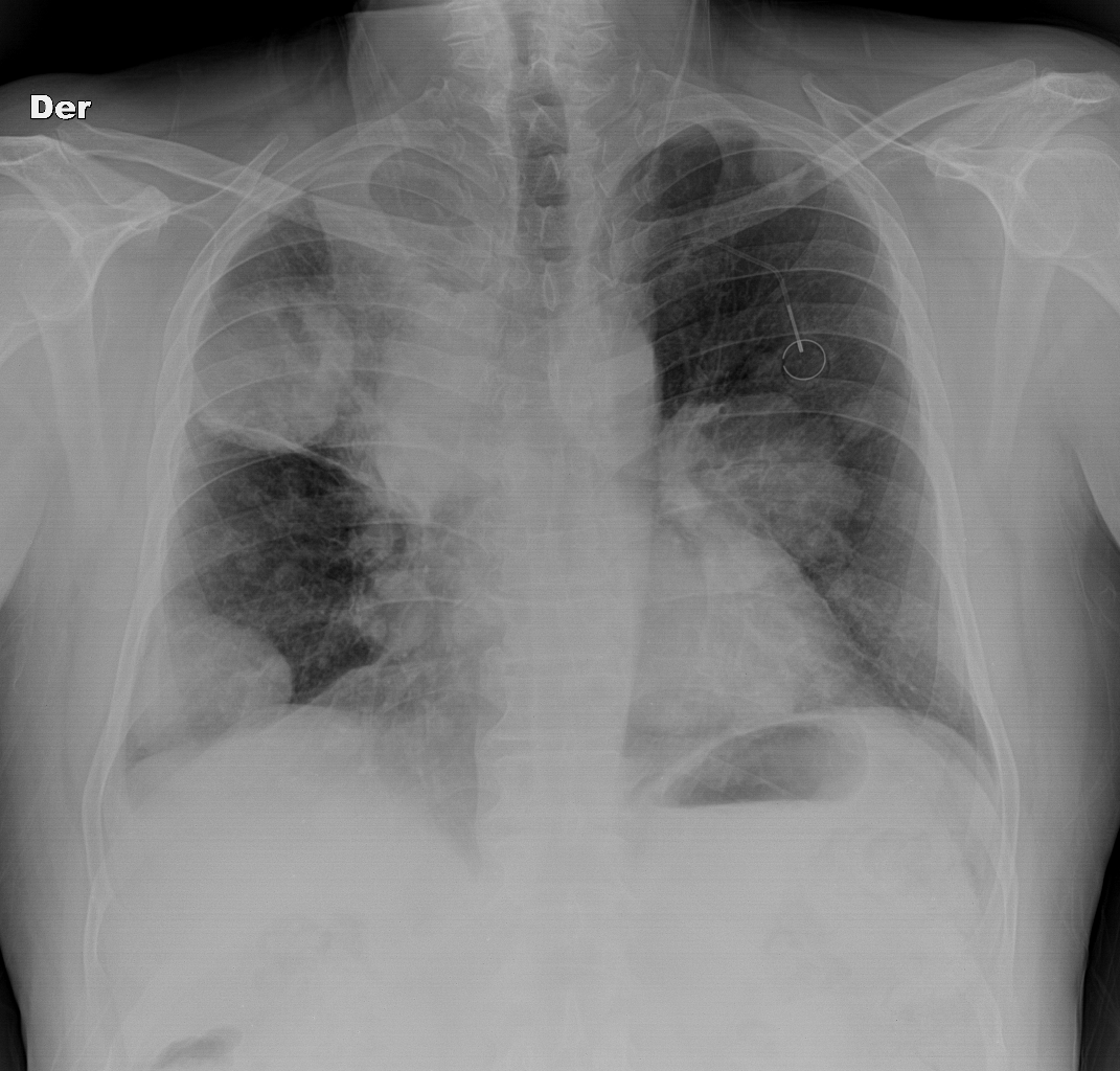 Lung metastases from colorectal cancer | Image | Radiopaedia.org