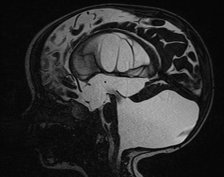 Dandy-Walker Malformation | Radiology Reference Article | Radiopaedia.org