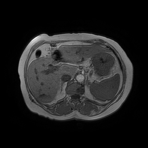 Gastrointestinal Stromal Tumor Gist Gastric Image 1664