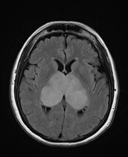 Bilateral and symmetric thalamic glioma | Image | Radiopaedia.org