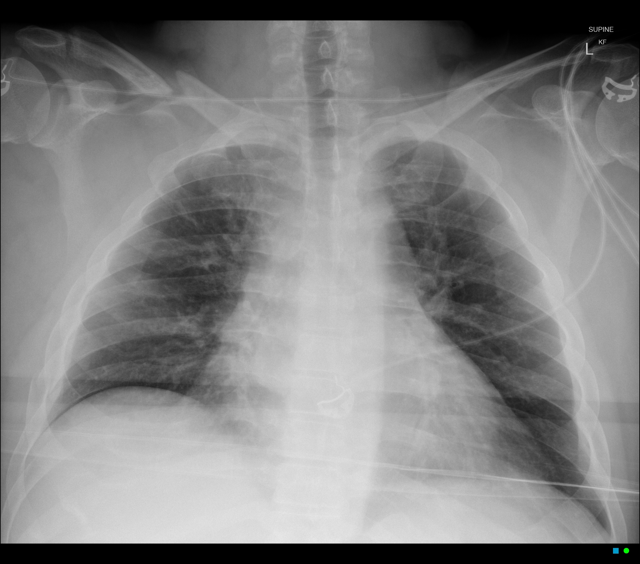 Traumatic pneumothorax - subtle (supine chest radiograph) | Image ...