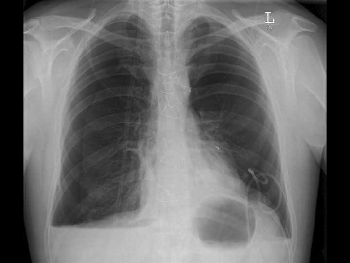 Buffalo pneumothorax - post-operative | Image | Radiopaedia.org