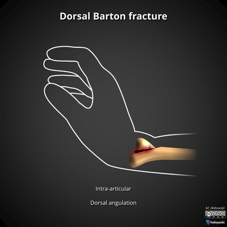 Barton fracture | Radiology Reference Article | Radiopaedia.org