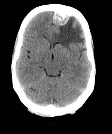 Atypical Meningioma - Brain Invasion 