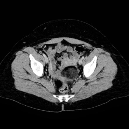 Uterine lipoleiomyoma | Radiology Reference Article | Radiopaedia.org