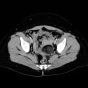 Uterine lipoleiomyoma | Radiology Reference Article | Radiopaedia.org