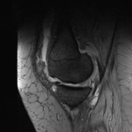 Spontaneous Osteonecrosis Of The Knee (sonk) 