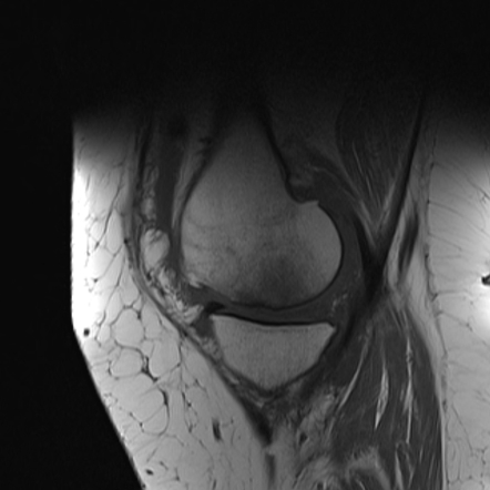 Spontaneous osteonecrosis of the knee (SONK) | Image | Radiopaedia.org