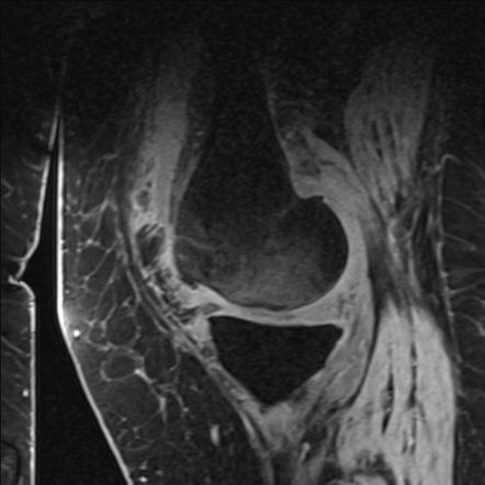 Spontaneous osteonecrosis of the knee (SONK) | Image | Radiopaedia.org