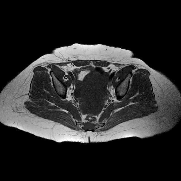 Femoral and spinal metastases - breast cancer | Radiology Case 