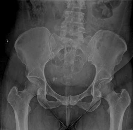 Femoral and spinal metastases - breast cancer | Radiology Case 