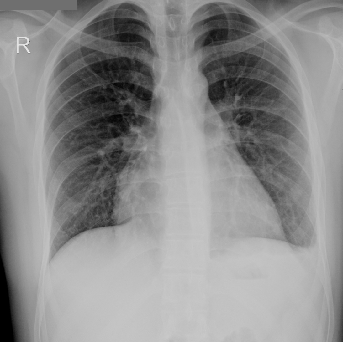 Pericardial effusion | Image | Radiopaedia.org