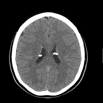 Subependymal hamartoma | Radiology Reference Article | Radiopaedia.org