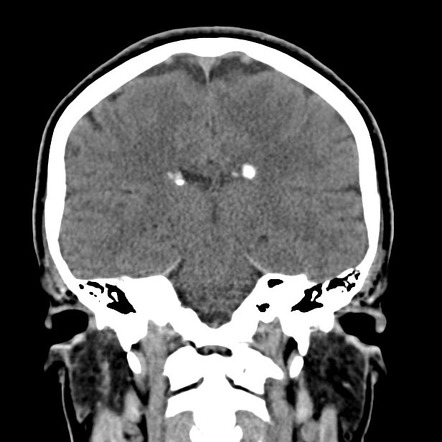 Subependymal hamartoma | Radiology Reference Article | Radiopaedia.org