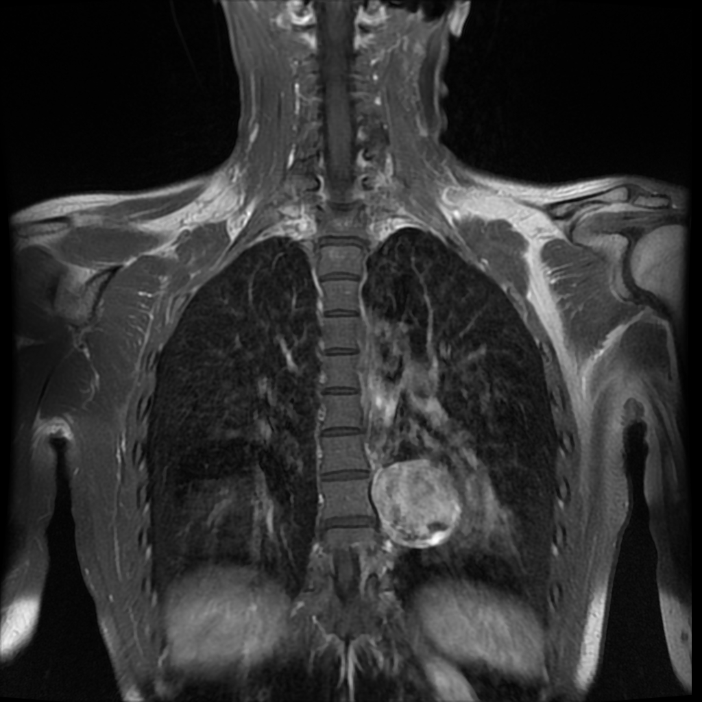 Spinal schwannoma | Image | Radiopaedia.org