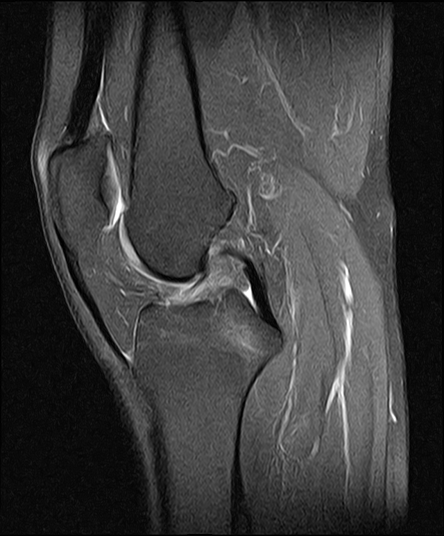 Chronic osteochondral fracture - lateral femoral trochlea | Image ...