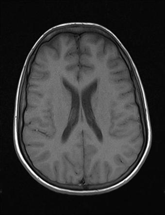 Rabies encephalitis | Image | Radiopaedia.org