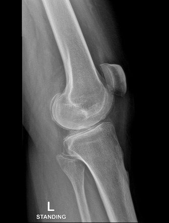 Chondrocalcinosis | Image | Radiopaedia.org