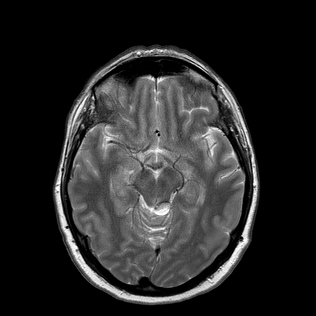 Quadrigeminal cistern lipoma | Image | Radiopaedia.org