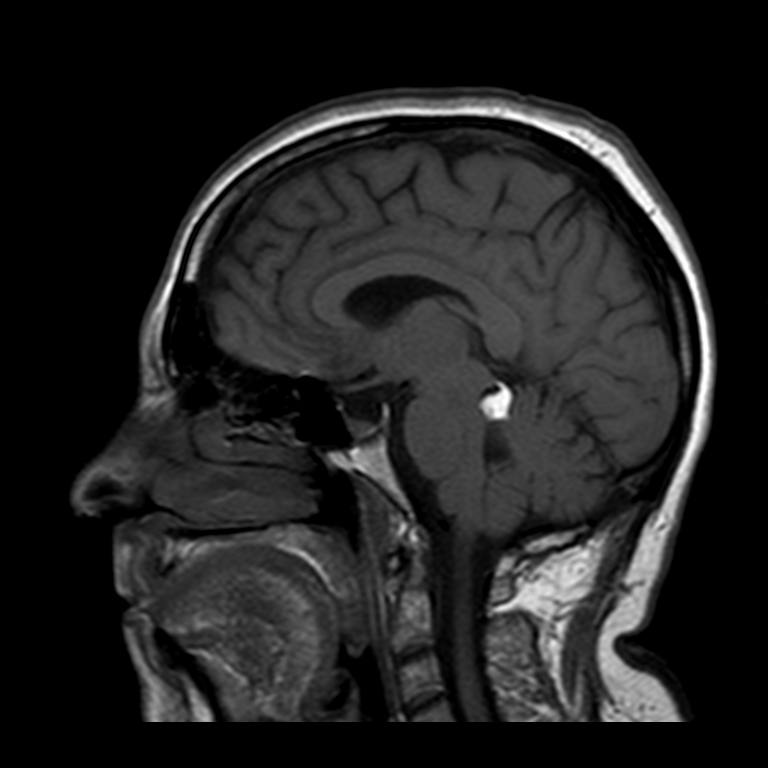 Quadrigeminal cistern lipoma | Image | Radiopaedia.org