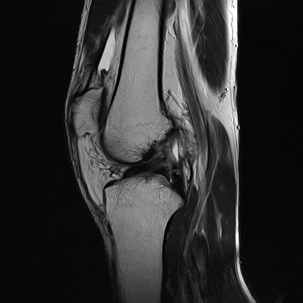 Anterior cruciate ligament tear - O'Donoghue unhappy triad | Radiology ...