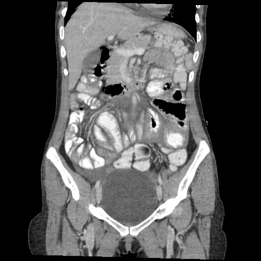 Abdominal cocoon | Image | Radiopaedia.org