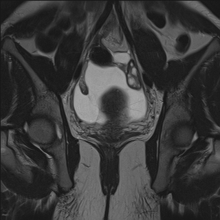 Peritoneal inclusion cyst | Image | Radiopaedia.org