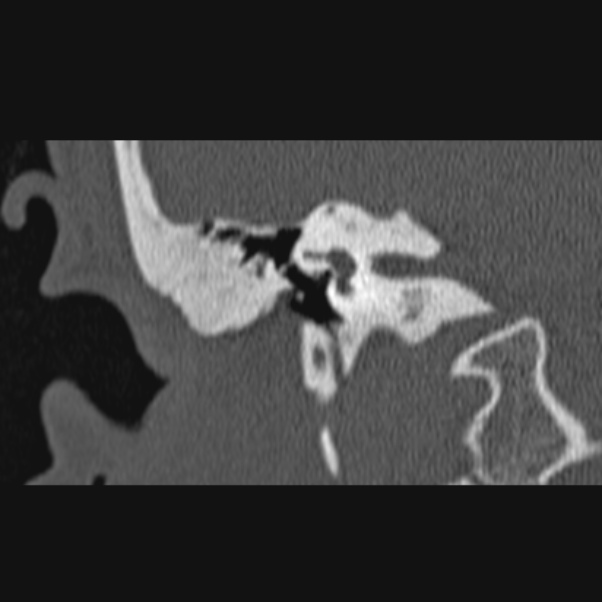 External auditory canal atresia | Image | Radiopaedia.org