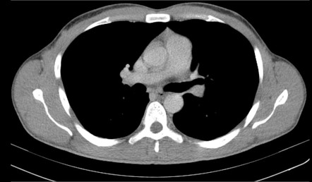 Metastasizing pleomorphic adenoma | Image | Radiopaedia.org