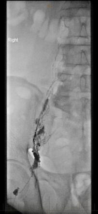 Thoracic duct embolization | Image | Radiopaedia.org