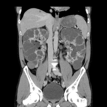 Autosomal Dominant Polycystic Kidney Disease | Radiology Case ...